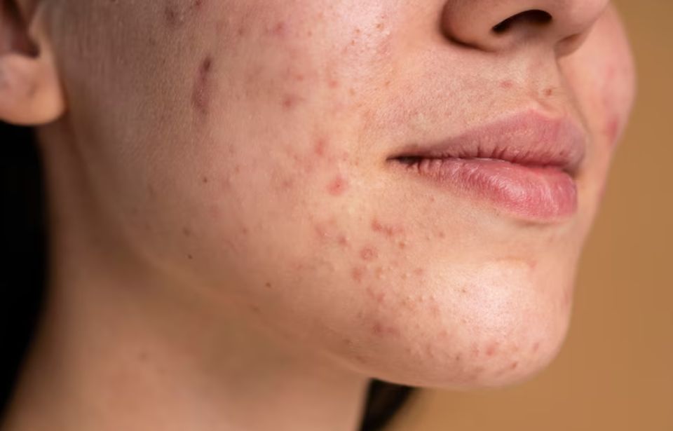 Acne (Pimples) & Acne scar treatment in tiruvannamalai