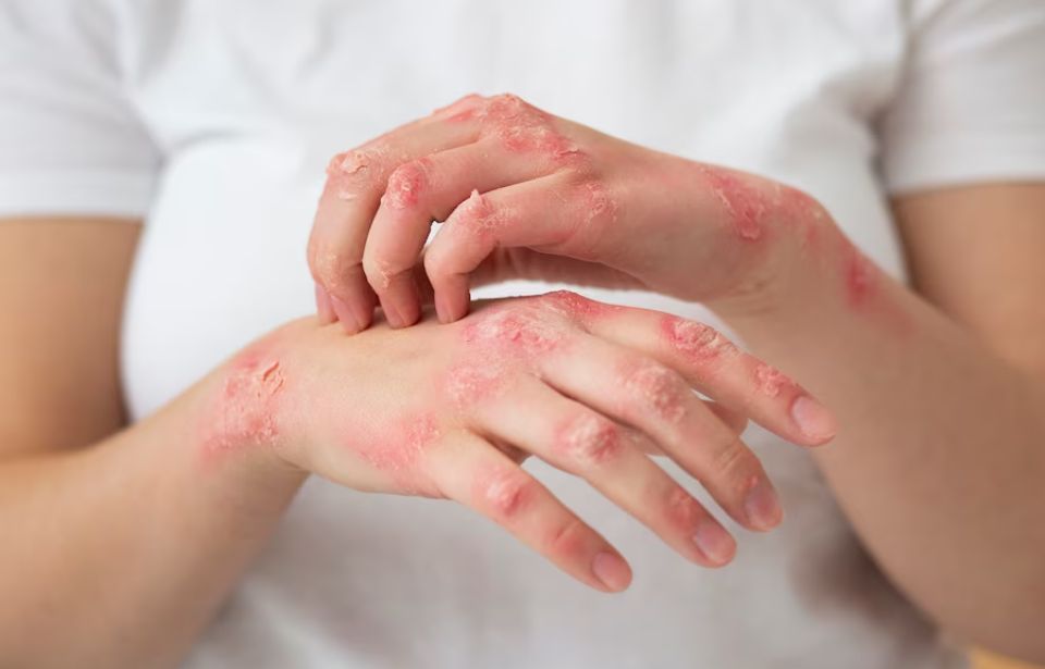Fungal & Other Skin Infections treatment in Tiruvannamalai