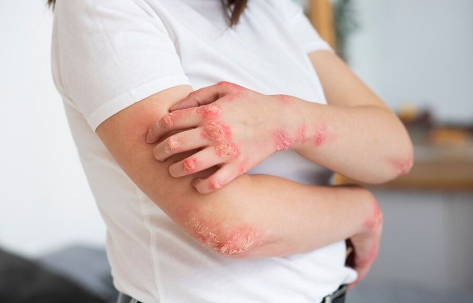 Psoriasis Eczema & Itching treatment in Tiruvannamalai