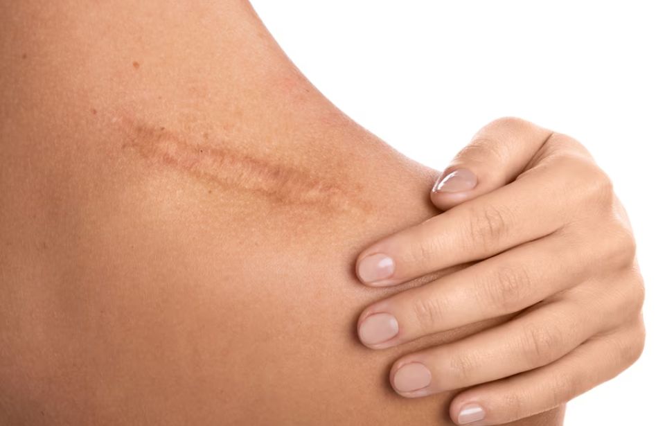 Scar Treatment in Tiruvannamalai