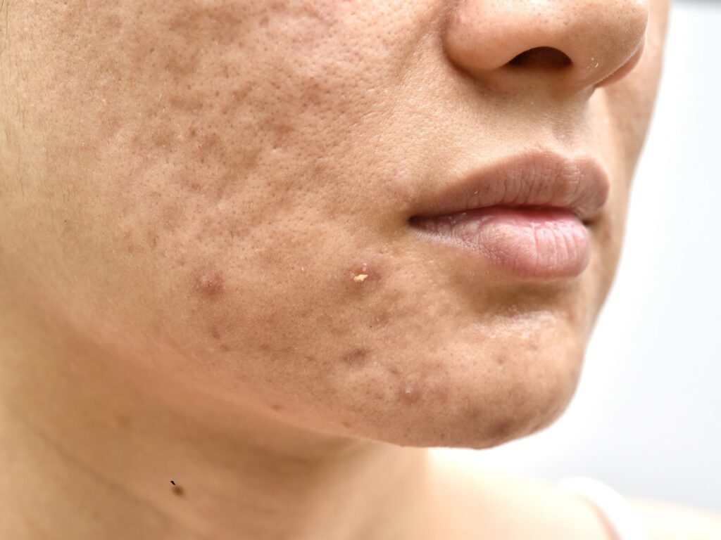 Acne and Scars