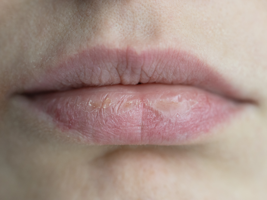 Pigmented Lip