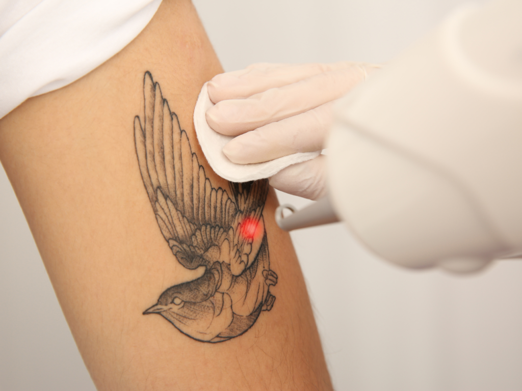 Unwanted Tattoos & Hair