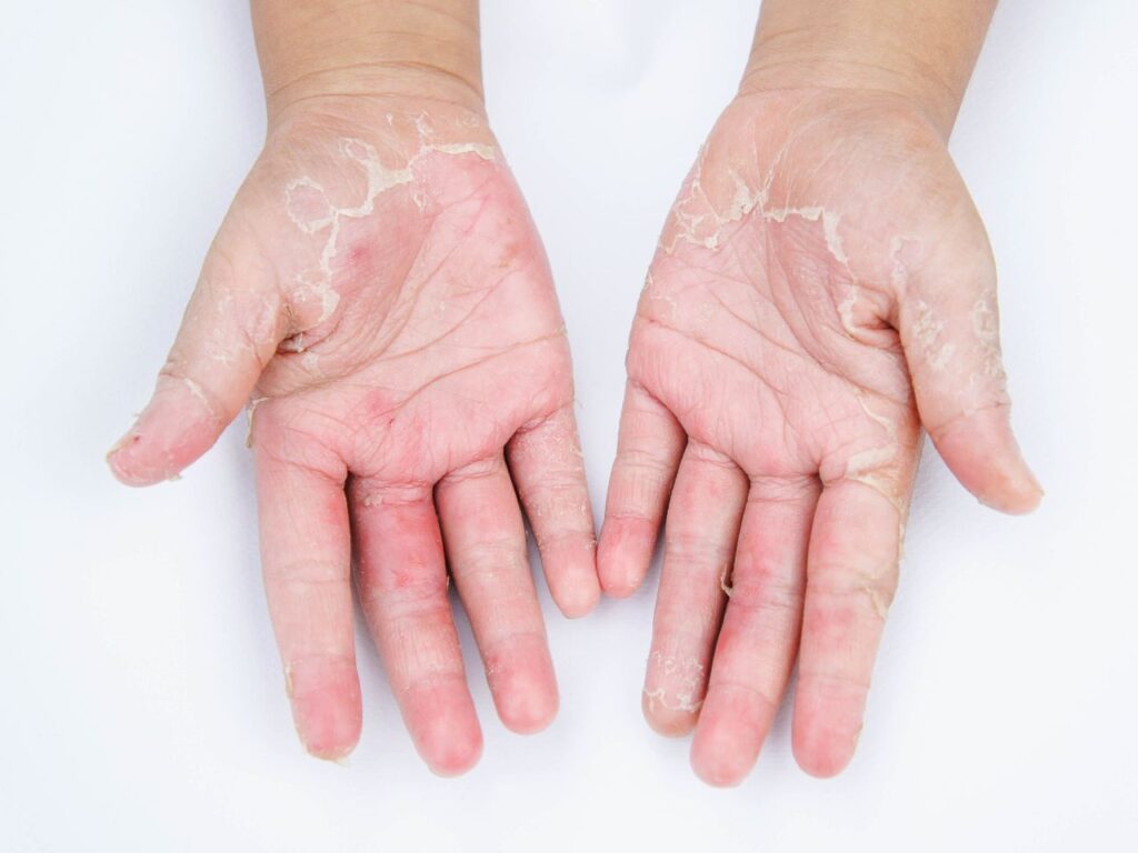 Fungal & Skin Infections