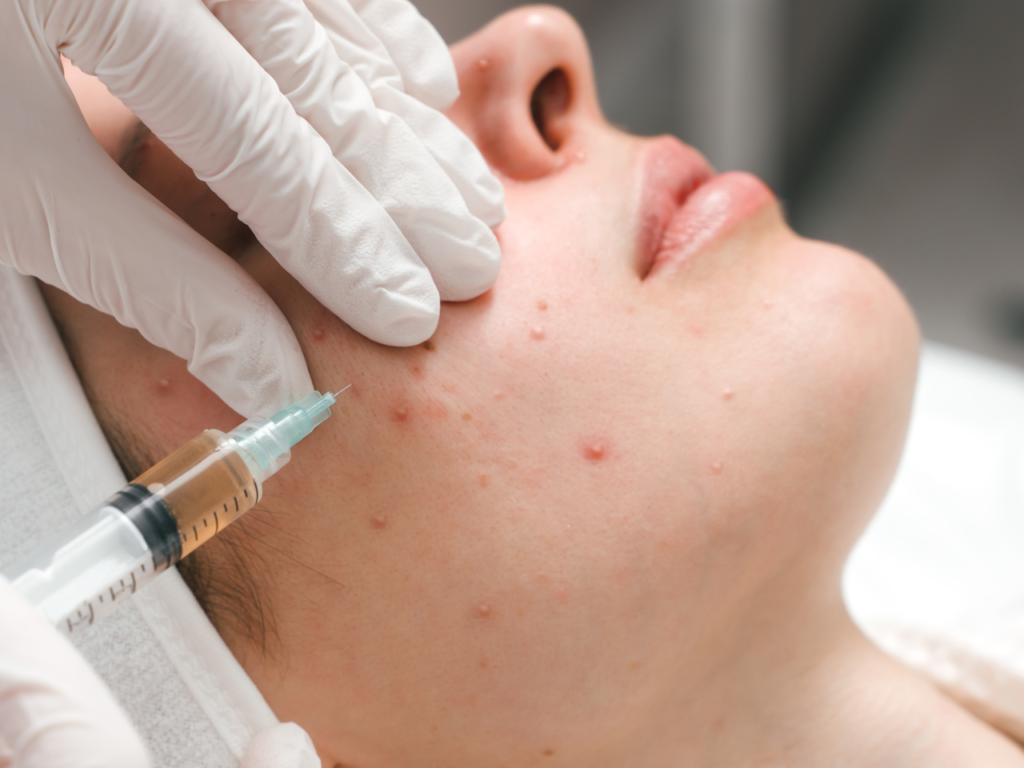 Pimples & Scars