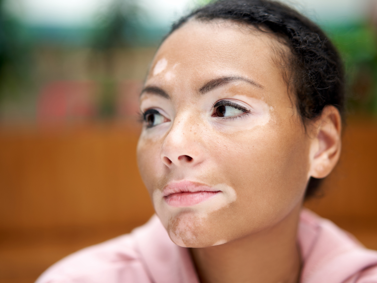 9 Breakthrough Vitiligo Treatment Options: Restore Skin Confidence Naturally